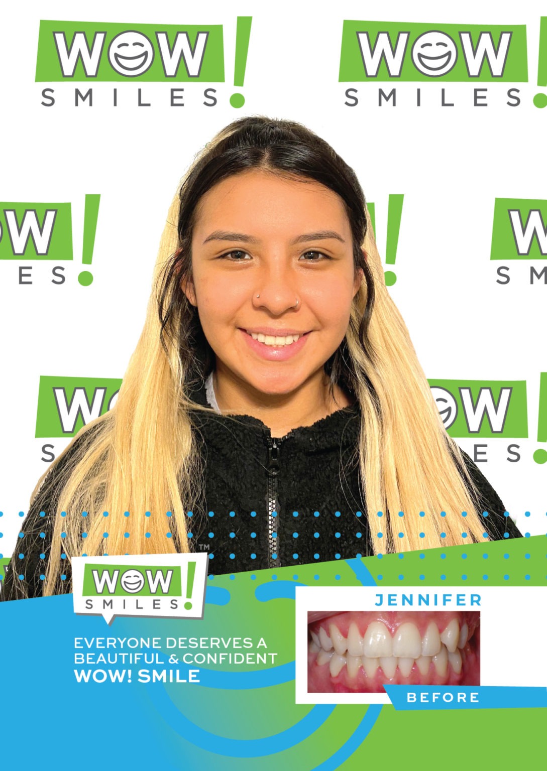 Orthodontic Before Afters Braces Invisalign Wow Smiles