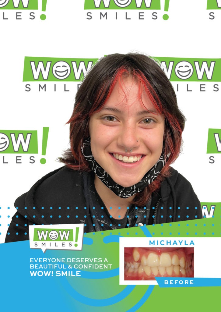 Orthodontic Before Afters Braces Invisalign Wow Smiles