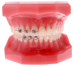 Comparison of metal braces and clear braces
