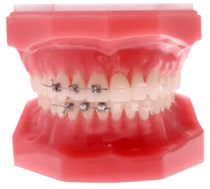 Comparison of metal braces and clear braces