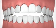 open-bite-tc.jpg open-bite-tc.jpg