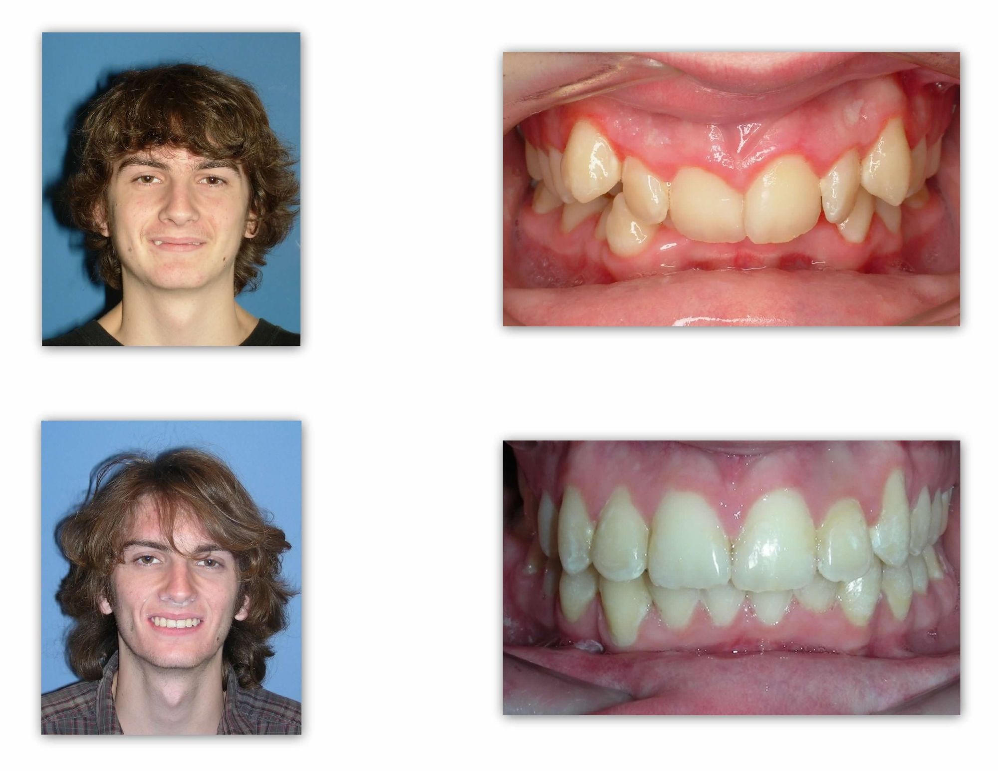 teen smile before and after braces