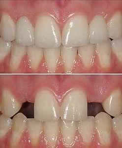 before and afters