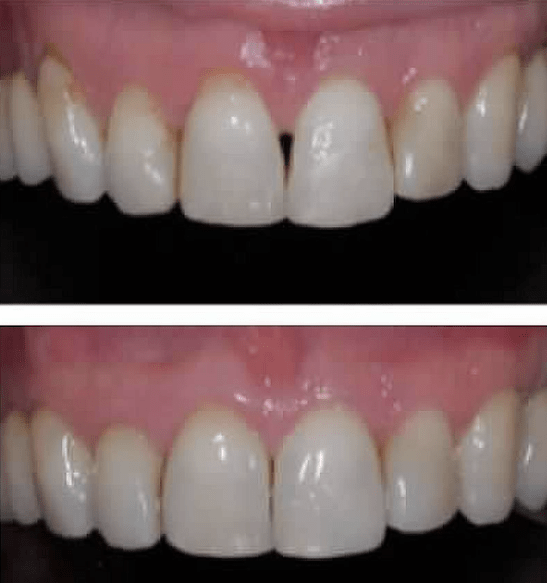 Cosmetic Dental Procedures Before and Afters | Wow Smiles