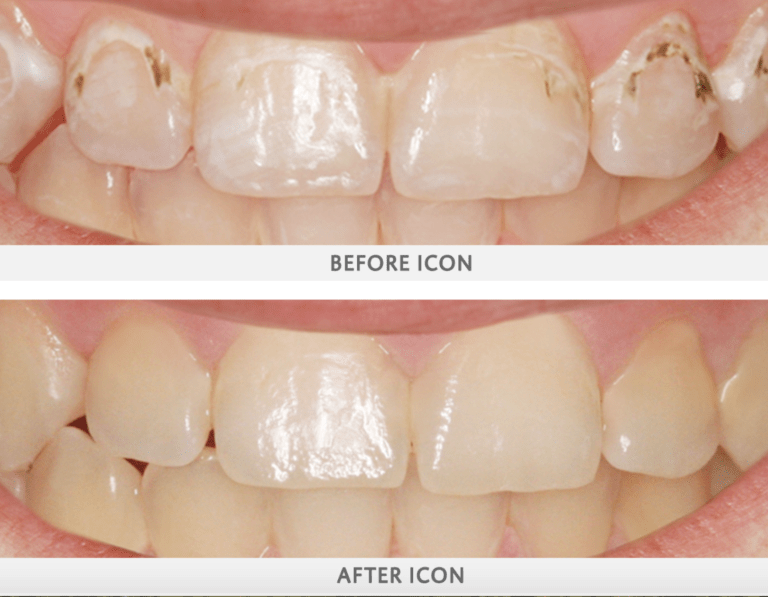 Icon-Resin-Treatment-2-768x597 before and afters