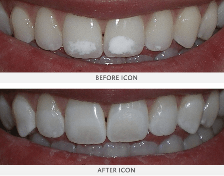 Icon-Resin-Treatment-768x603 before and afters