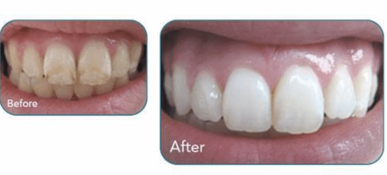MI-Paste-BA-768x348 before and afters