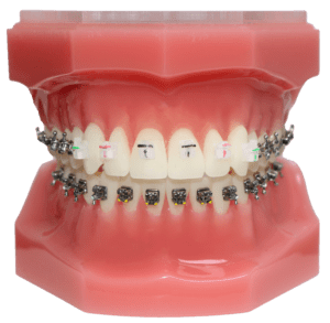 Clear21 Typodont Braces