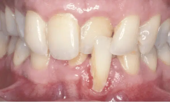 Anteior Crossbite
