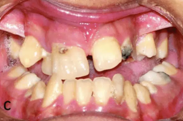 Cranio-facial Anomoly