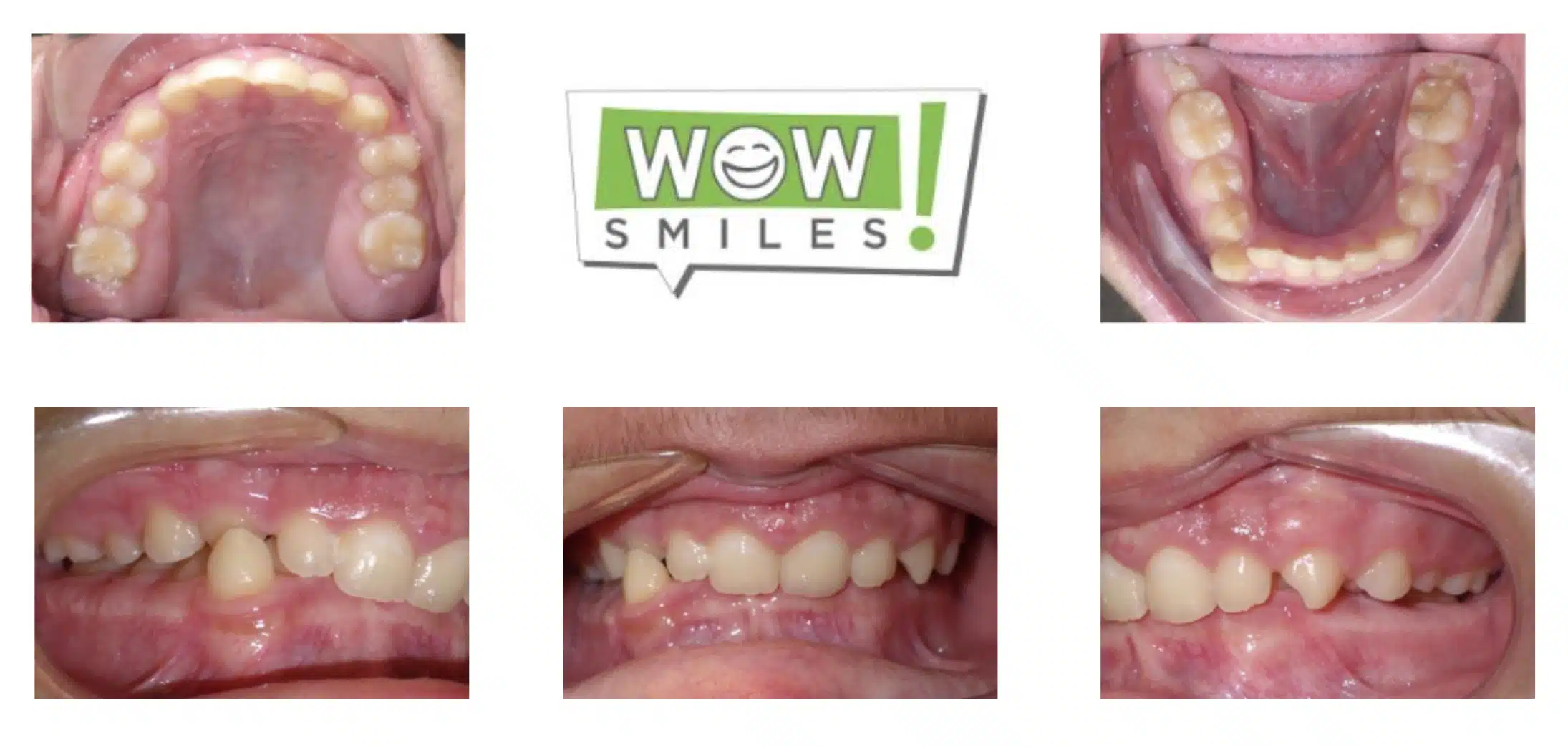 DEEP IMPINGING OVERBITE 2