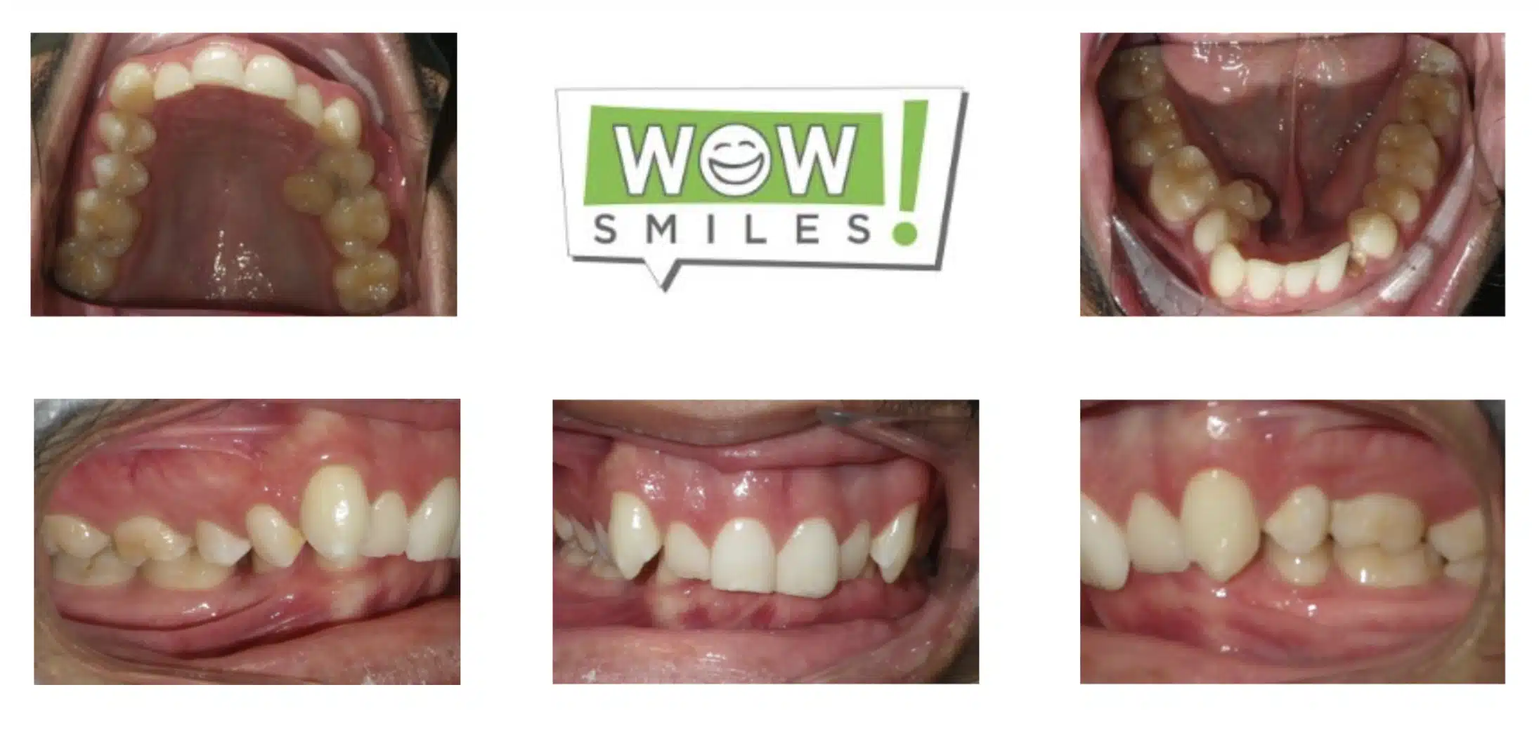 DEEP IMPINGING OVERBITE