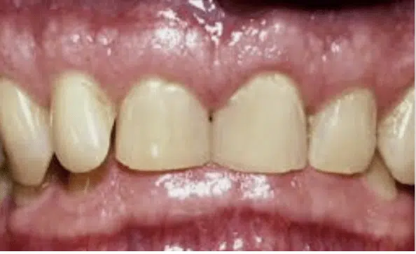Deep, Impinging Overbite