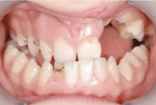 Severe Traumatic Deviation