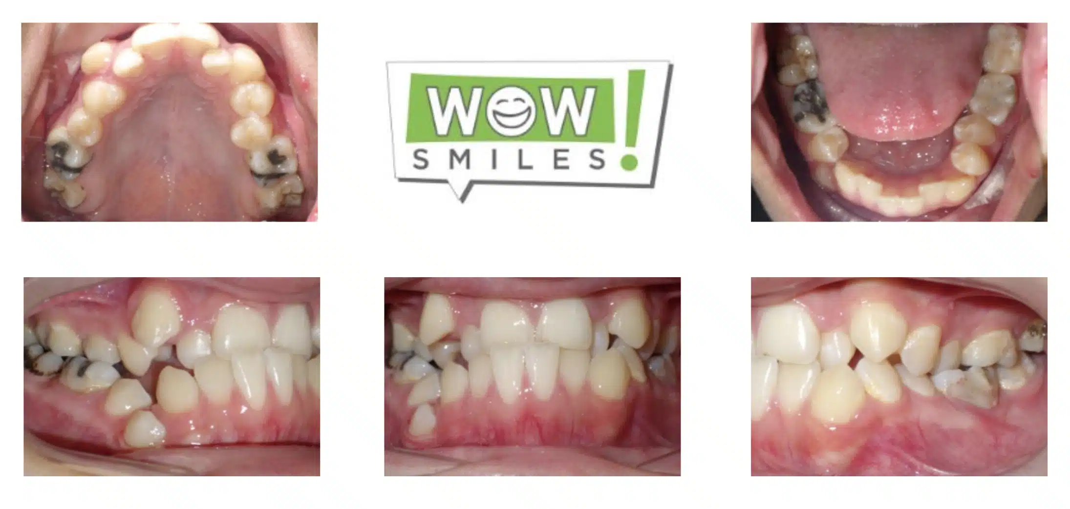 UNDERBITE + SEVERE CROWDING