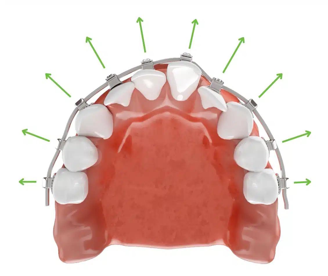 Berni-Tube-expansion