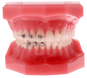 Comparison of metal braces and clear braces