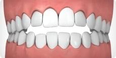 open-bite-tc.jpg