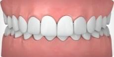 overbite-tc.jpg